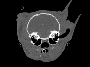 CT Lateral ear canal resection